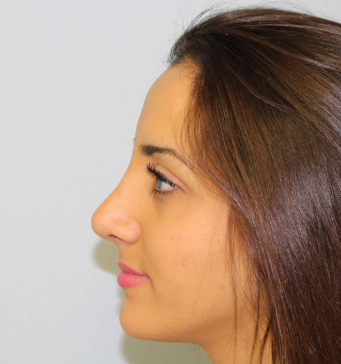 Rhinoplasty