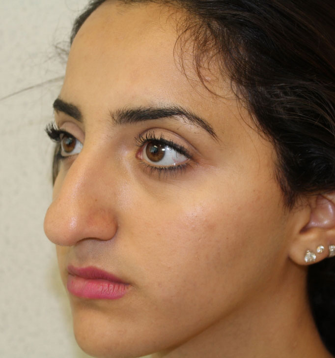 Rhinoplasty