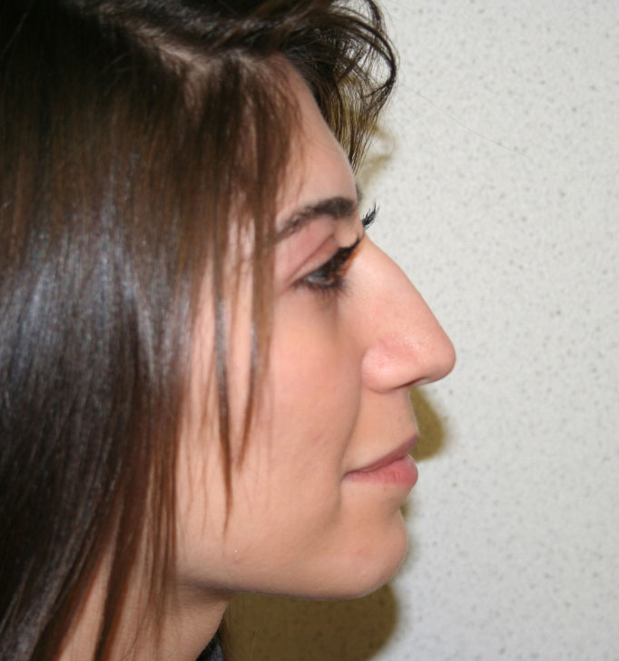 Rhinoplasty