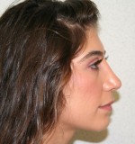 Rhinoplasty