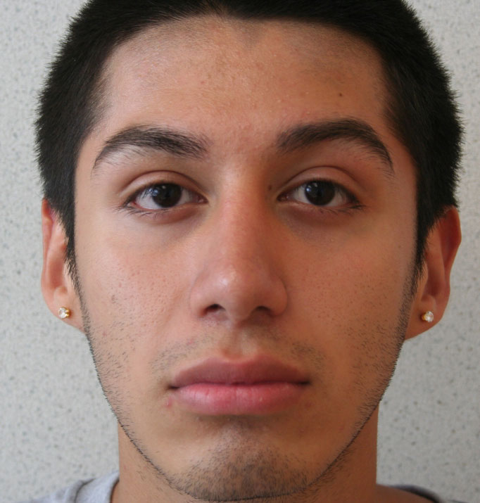 Rhinoplasty