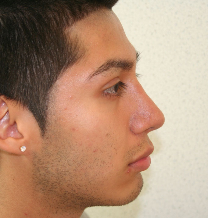 Rhinoplasty