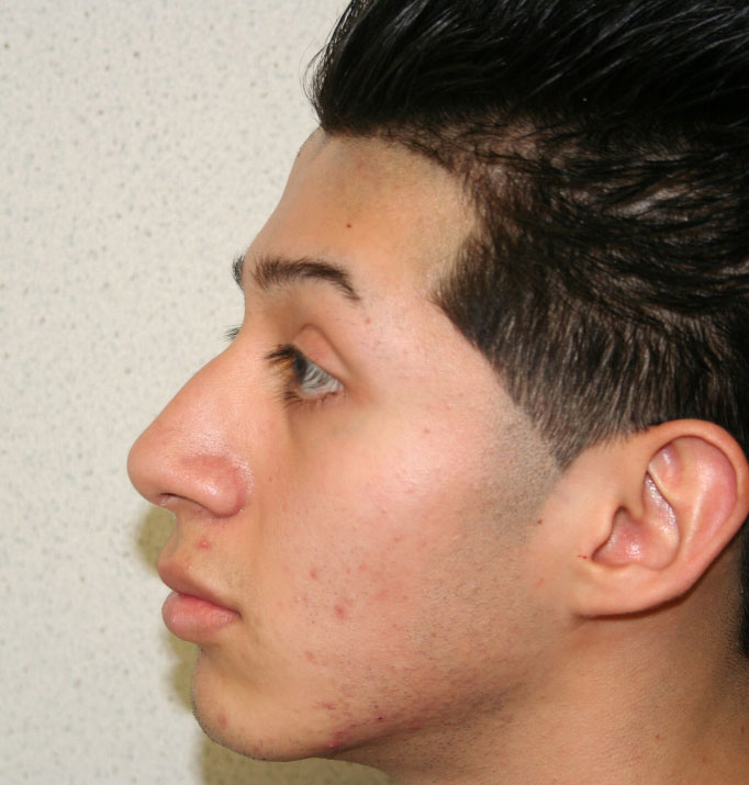 Rhinoplasty