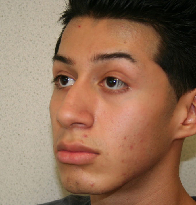 Rhinoplasty