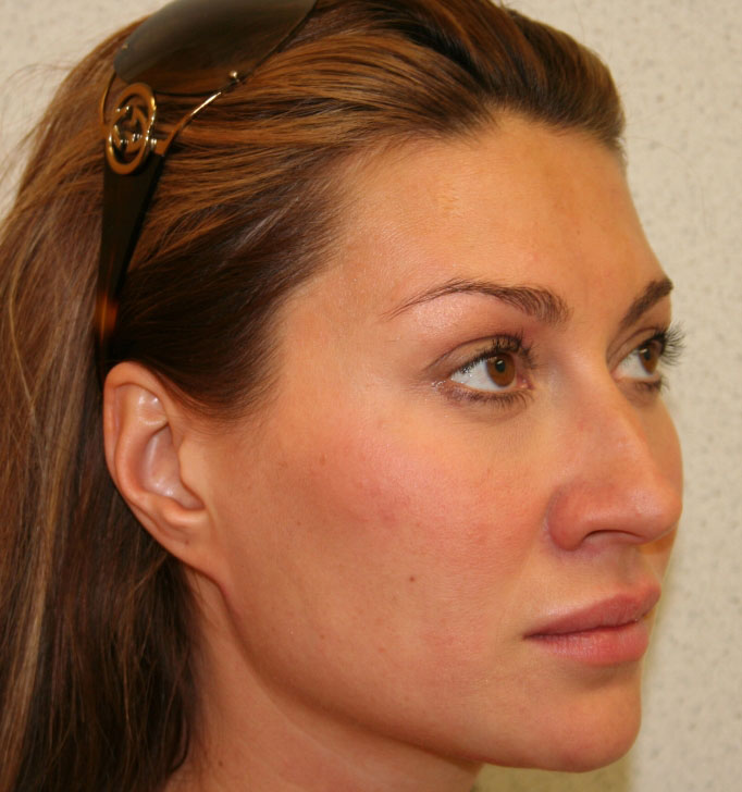 Rhinoplasty