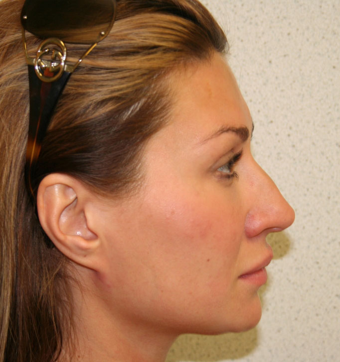 Rhinoplasty