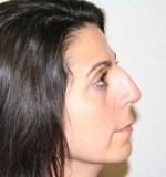 Rhinoplasty