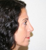 Rhinoplasty