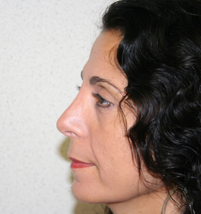 Rhinoplasty