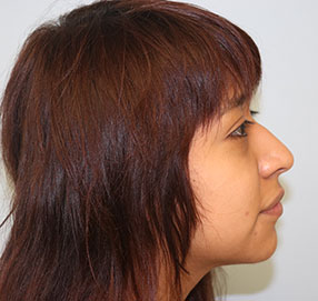 Rhinoplasty