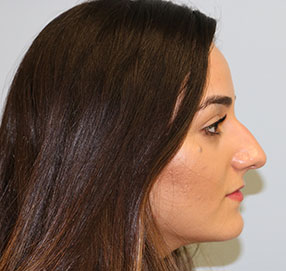 Rhinoplasty