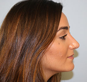 Rhinoplasty