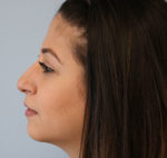 Rhinoplasty