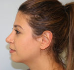 Rhinoplasty