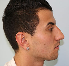 Rhinoplasty