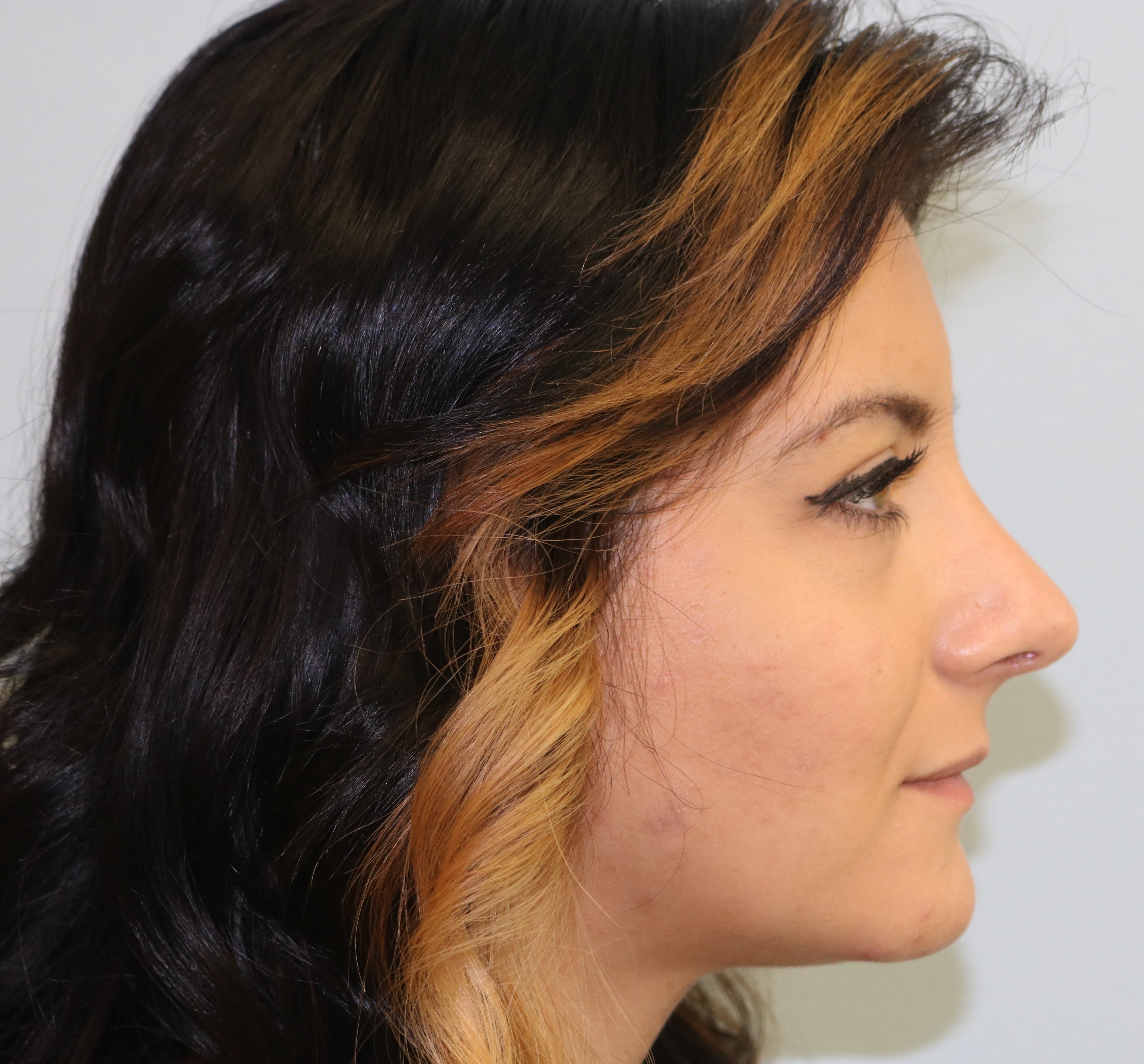 Rhinoplasty