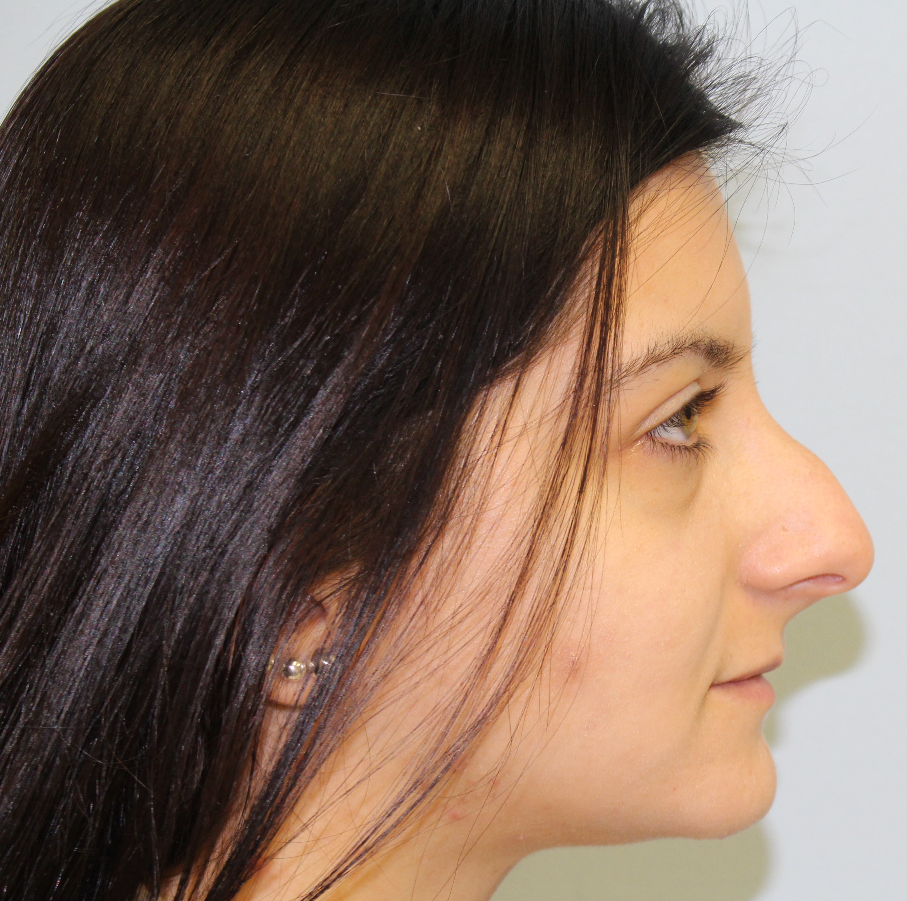 Rhinoplasty