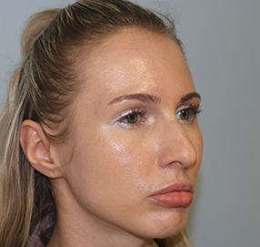 Rhinoplasty