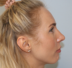 Rhinoplasty