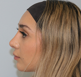 Rhinoplasty