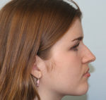 Rhinoplasty