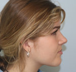 Rhinoplasty