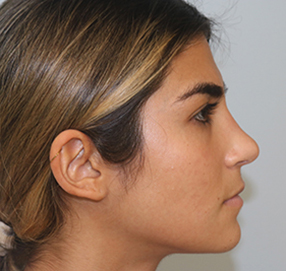 Rhinoplasty