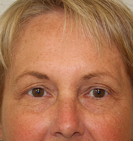 Blepharoplasty