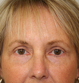 Blepharoplasty