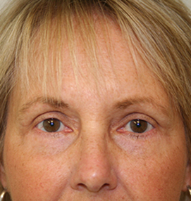 Blepharoplasty