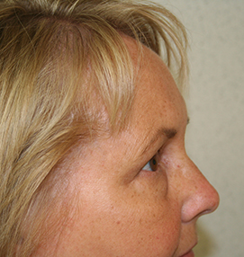 Blepharoplasty