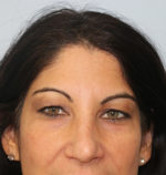 Blepharoplasty