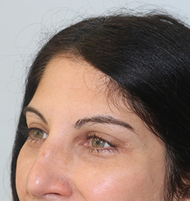 Blepharoplasty