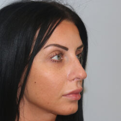 Rhinoplasty