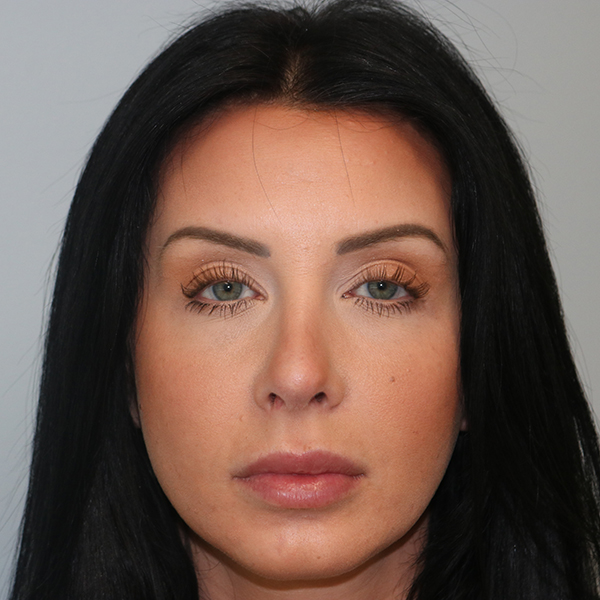 Rhinoplasty