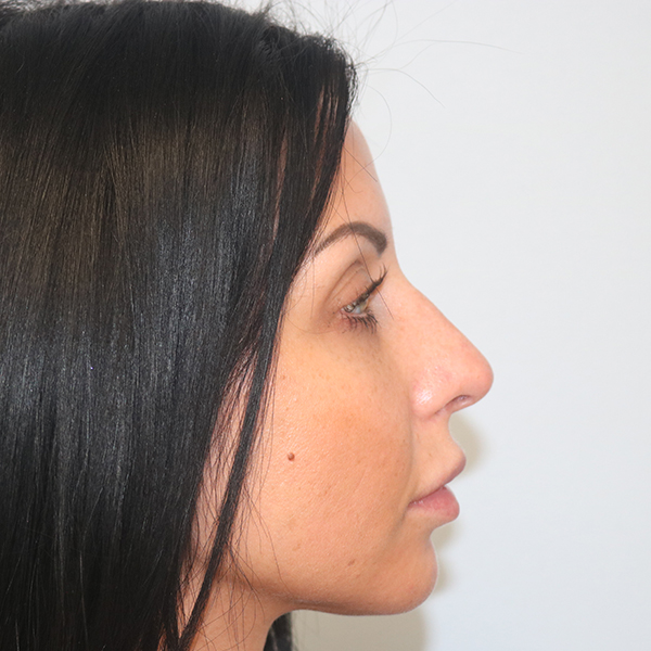 Rhinoplasty