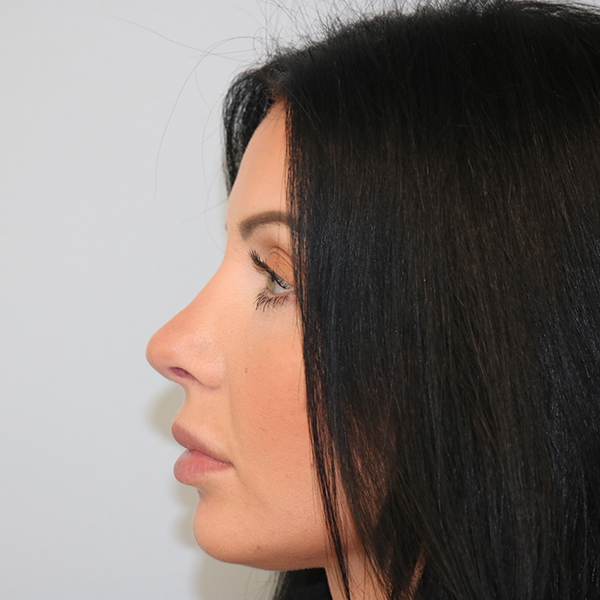 Rhinoplasty