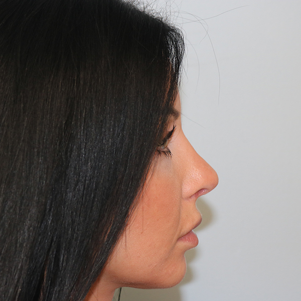 Rhinoplasty