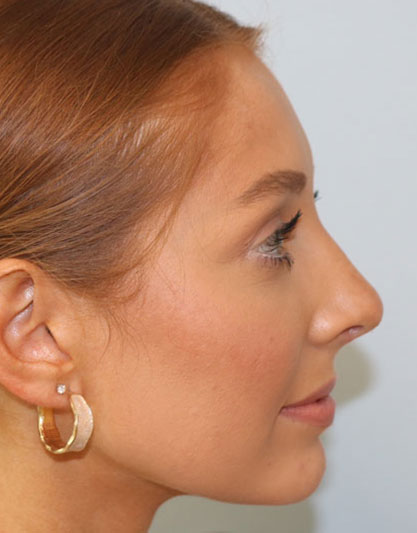 Rhinoplasty