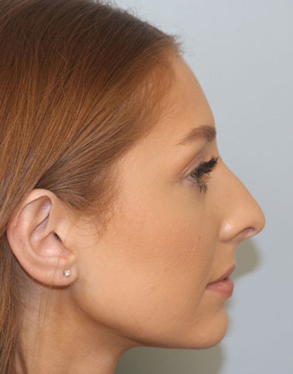 Rhinoplasty