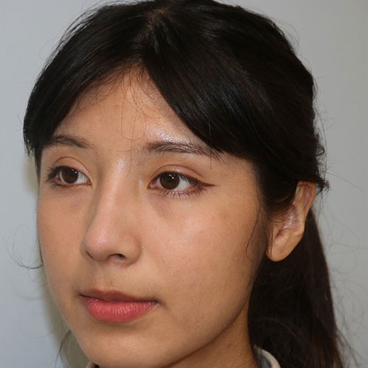 Rhinoplasty