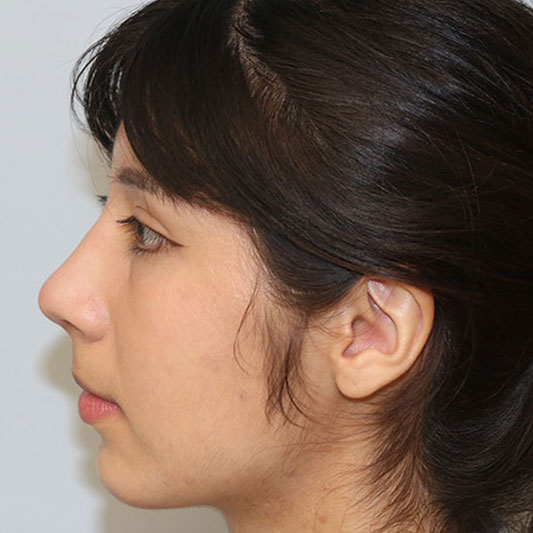 Rhinoplasty