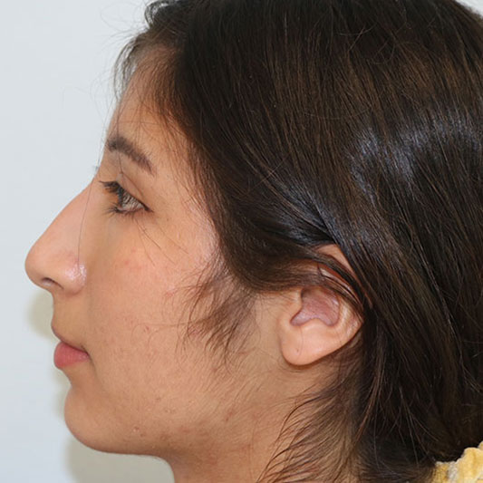 Rhinoplasty