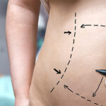 10 Things You Need to Know Before Considering a Tummy Tuck