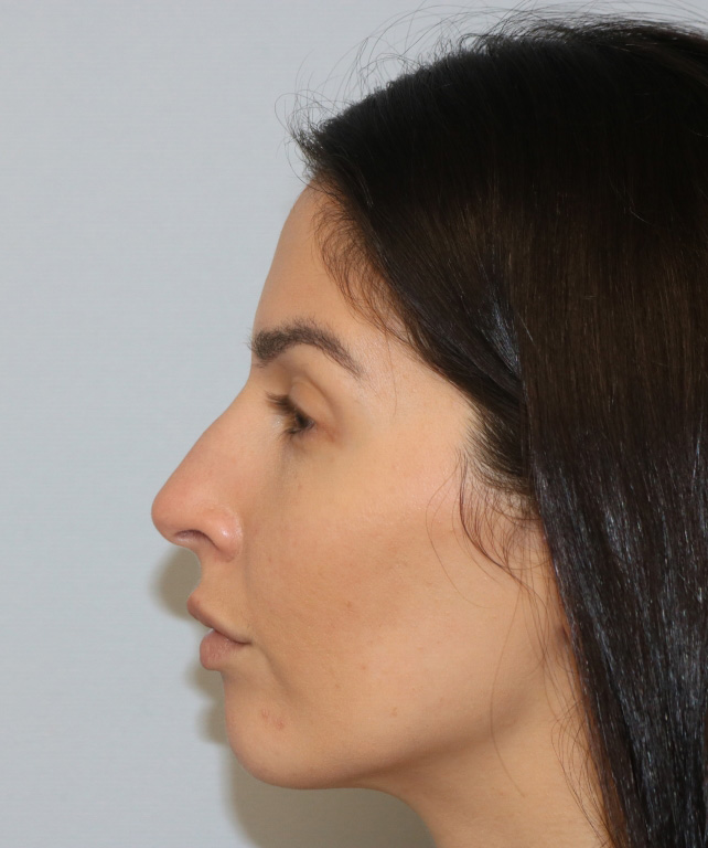 Rhinoplasty