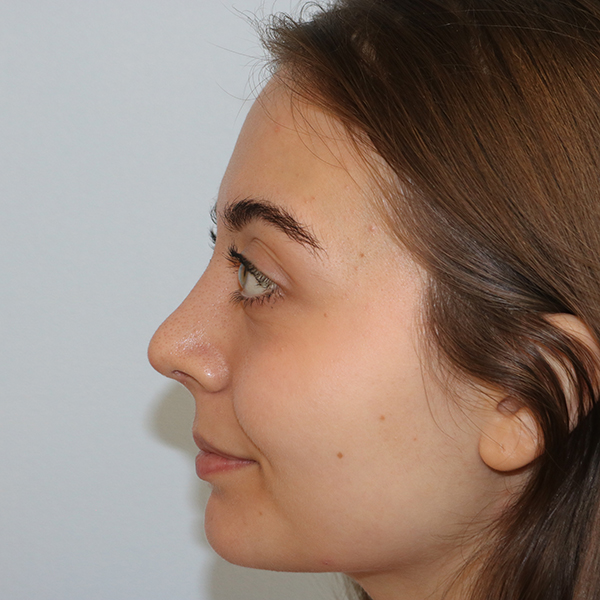 Rhinoplasty