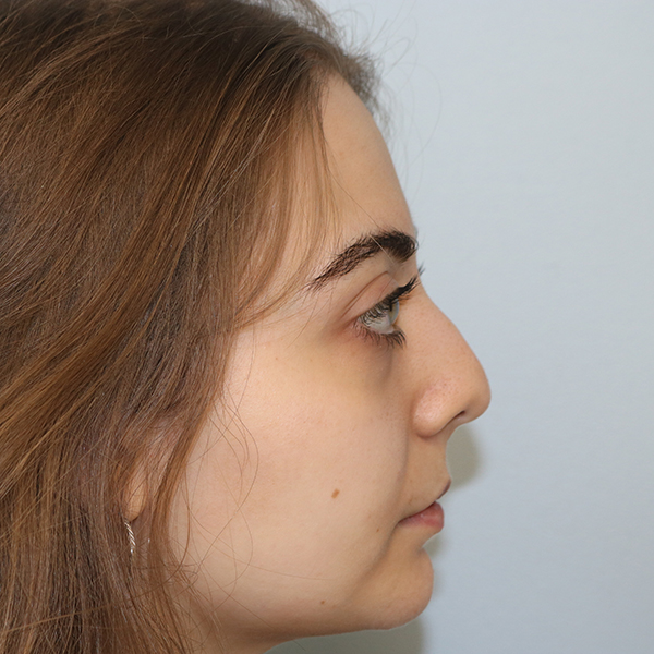 Rhinoplasty