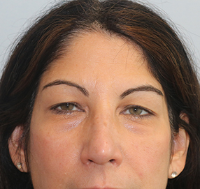 Blepharoplasty