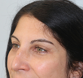 Blepharoplasty