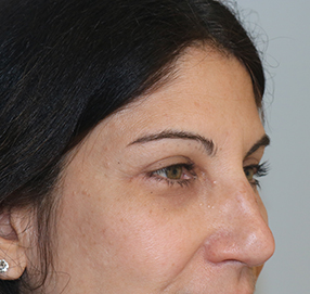 Blepharoplasty
